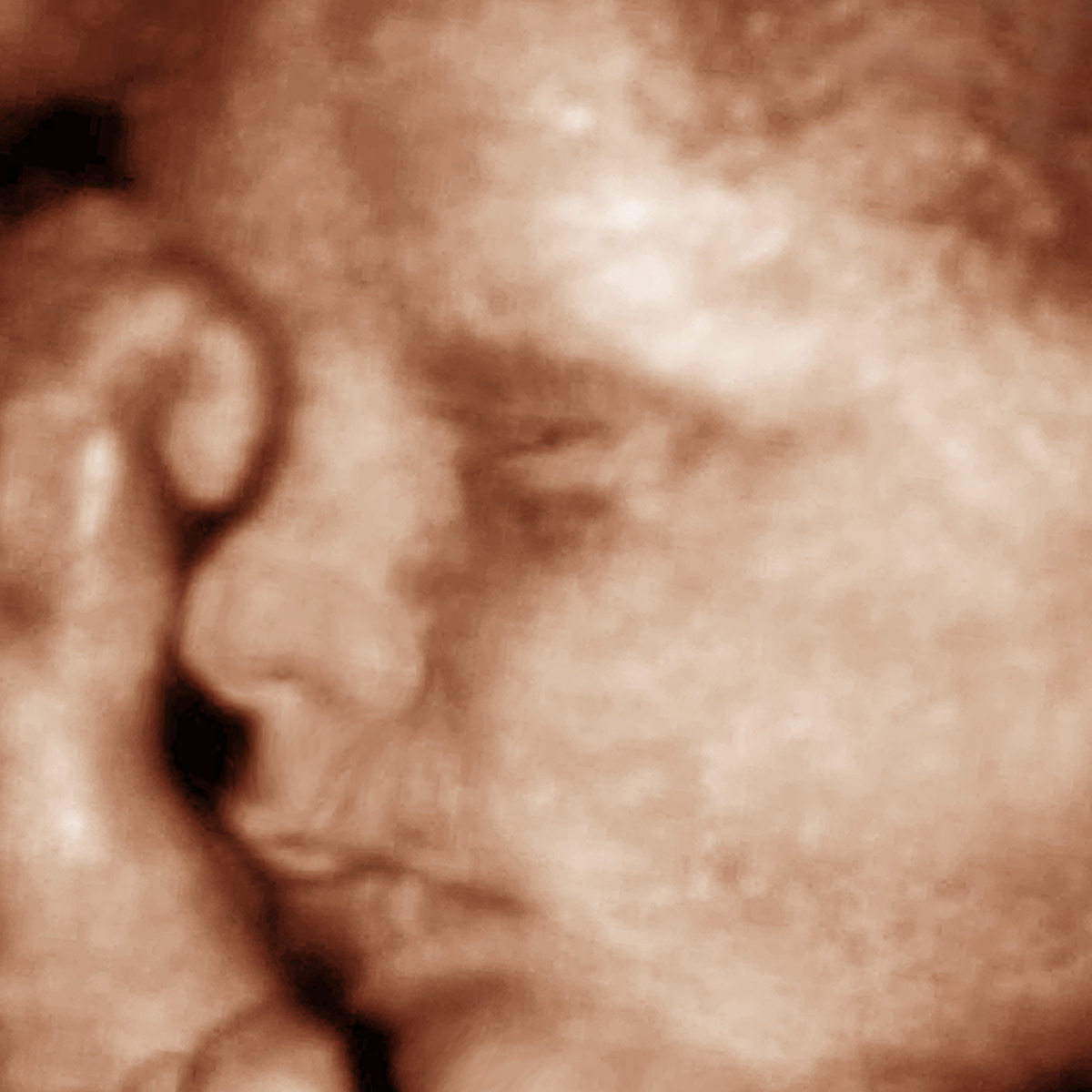 3D Ultrasound scan 3
